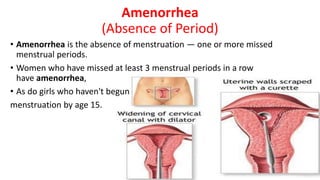 Treatment and causes of Amenorrhea and diet in amenorrhea | PPT