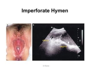 Imperforate Hymen
O Warda
uterus
vagina
 