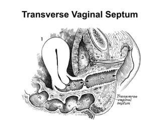 Transverse Vaginal Septum
O Warda
 