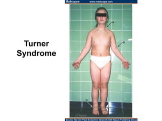 Turner
Syndrome
O Warda
 