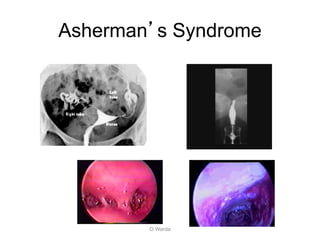 Asherman’s Syndrome
O Warda
 