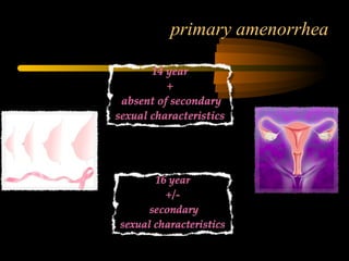 primary amenorrhea
 