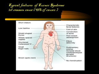 Typical features of Turner SyndromeTurner Syndrome
1st commen cause (45% of causes )1st commen cause (45% of causes )
 