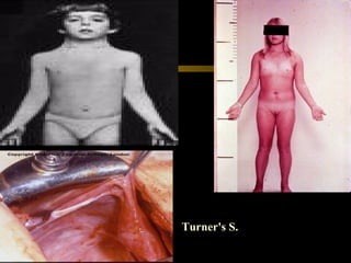 Turner's S.
 