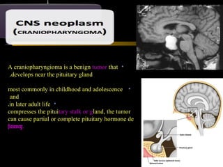 •A craniopharyngioma is a benign tumor that
develops near the pituitary gland.
•most commonly in childhood and adolescence
and
•in later adult life.
compresses the pituitary stalk or gland, the tumor
can cause partial or complete pituitary hormone de
ficiency.
 