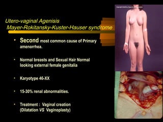 Utero-vaginal Agenisis
Mayer-Rokitansky-Kuster-Hauser syndrome
• Second most common cause of Primary
amenorrhea.
• Normal breasts and Sexual Hair Normal
looking external female genitalia
• Karyotype 46-XX
• 15-30% renal abnormalities.
• Treatment : Vaginal creation
(Dilatation VS Vaginoplasty)
 