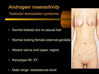 • Normal breasts but no sexual hair
• Normal looking female external genitalia
• Absent uterus and upper vagina
• Karyotype 46, XY
• Male range testosterone level
Androgen insensitivity
Testicular feminization syndrome
 