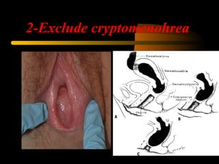 2-Exclude cryptomenohrea
 