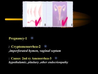 ✴1-Pregnancy
✴2-Cryptomenorrhea:
imperforated hymen, vaginal septum,
✴3-Causes 2nd ry Amenorrhea:
hypothalamic, pituitary ,other endocrionpathy
 