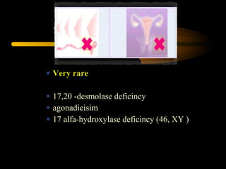 Very rare
17,20 -desmolase deficincy
agonadieisim
17 alfa-hydroxylase deficincy (46, XY )
 