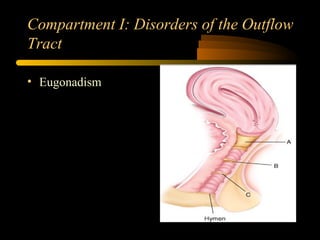 Compartment I: Disorders of the Outflow
Tract
• Eugonadism
 