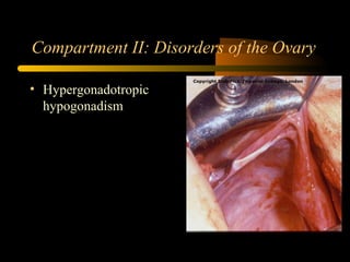 Compartment II: Disorders of the Ovary
• Hypergonadotropic
hypogonadism
 