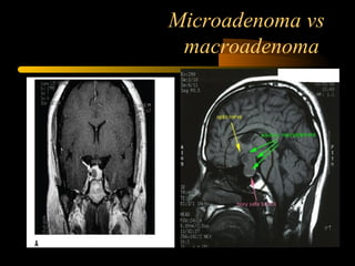 Microadenoma vs
macroadenoma
 