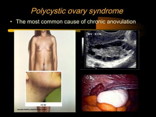 Polycystic ovary syndrome
• The most common cause of chronic anovulation
 