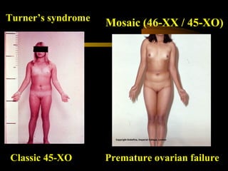 Classic 45-XO Premature ovarian failure
Turner’s syndrome
Mosaic (46-XX / 45-XO)
 