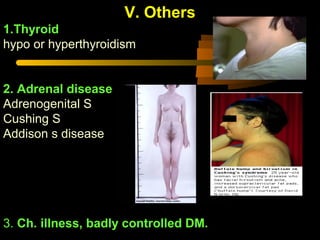 V. Others
1.Thyroid
hypo or hyperthyroidism
2. Adrenal disease
Adrenogenital S
Cushing S
Addison s disease
3. Ch. illness, badly controlled DM.
 