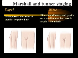Stage1 stage2
Prepupertal: elevation of
papilla- no pubic hair
Elevation of breast and papilla
on a small mount,increase in
areola – libial hair
Marshall and tunner staging
 