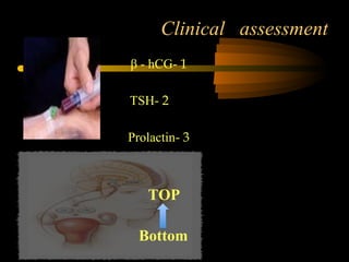 Clinical assessment
1-β - hCG
2-TSH
3-Prolactin
TOP
Bottom
 