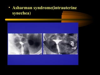 • Asharman syndrome(intrauterine
synechea)
 
