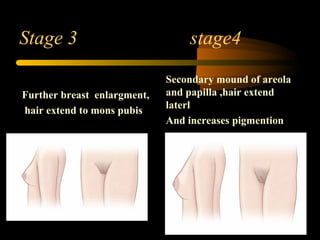 Stage 3 stage4
Further breast enlargment,
hair extend to mons pubis
Secondary mound of areola
and papilla ,hair extend
laterl
And increases pigmention
 