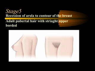 Stage5
Recession of arola to contour of the breast
Adult pubertal hair with striaght upper
borded
 