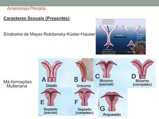 Amenorreia Primária
Caracteres Sexuais (Presentes):
Síndrome de Mayer-Rokitansky-Küster-Hauser
Má-formações
Mulleriana
 