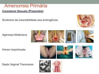 Amenorreia Primária
Caracteres Sexuais (Presentes):
Síndrome da insensibilidade aos androgênios
Agenesia Mulleriana
Himen imperfurado
Septo Vaginal Transverso
 