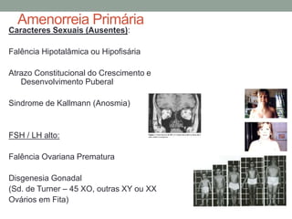 Amenorreia Primária
Caracteres Sexuais (Ausentes):
Falência Hipotalâmica ou Hipofisária
Atrazo Constitucional do Crescimento e
Desenvolvimento Puberal
Sindrome de Kallmann (Anosmia)
FSH / LH alto:
Falência Ovariana Prematura
Disgenesia Gonadal
(Sd. de Turner – 45 XO, outras XY ou XX
Ovários em Fita)
 