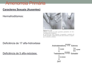 Amenorreia Primária
Caracteres Sexuais (Ausentes):
Hermafroditismos:
Deficiência de 17 alfa-hidroxilase
Deficiência de 5 alfa-redutase.
 