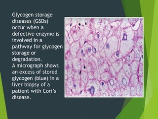 Glycogen storage
diseases (GSDs)
occur when a
defective enzyme is
involved in a
pathway for glycogen
storage or
degradation.
A micrograph shows
an excess of stored
glycogen (blue) in a
liver biopsy of a
patient with Cori’s
disease.
 