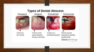 American Association of Endodontics guidelines on pulpal diagnosis.pptx
