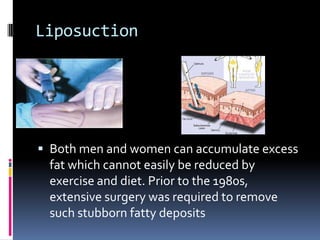 Liposuction	Both men and women can accumulate excess fat which cannot easily be reduced by exercise and diet. Prior to the 1980s, extensive surgery was required to remove such stubborn fatty deposits