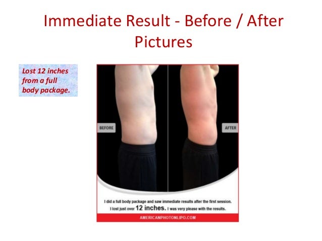 American Photon Lipo Centers Reviews Burr Ridge Il