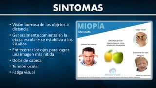 • Visión borrosa de los objetos a
distancia
• Generalmente comienza en la
etapa escolar y se estabiliza a los
20 años
• Entrecerrar los ojos para lograr
una imagen más nítida
• Dolor de cabeza
• Tensión ocular
• Fatiga visual
SINTOMAS
 