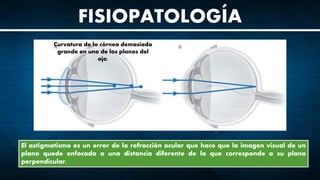 FISIOPATOLOGÍA
El astigmatismo es un error de la refracción ocular que hace que la imagen visual de un
plano quede enfocada a una distancia diferente de la que corresponde a su plano
perpendicular.
Curvatura de la córnea demasiado
grande en uno de los planos del
ojo.
 