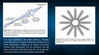 Los rayos luminosos del plano vertical, señalado
como BD, sufren una gran refracción al pasar por la
lente astigmática debido a su mayor curvatura
vertical que horizontal. Por el contrario, los del
plano horizontal, indicado como AC, no se desvían
ni de lejos tanto como los del plano vertical BD.
 