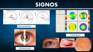 SIGNOS
QUERATOMETRO
TOPOGRAFO
RETINOSCOPIA
• CONJUNTIVITIS
• BLEFARITIS
• PSEUDO EDEMA DE PAPILA
 