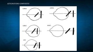 ASTIGMATISMO COMPUESTO
 