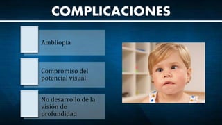 COMPLICACIONES
Ambliopía
Compromiso del
potencial visual
No desarrollo de la
visión de
profundidad
 
