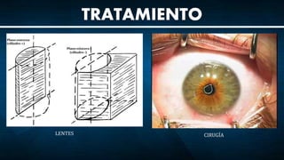 TRATAMIENTO
LENTES CIRUGÍA
 