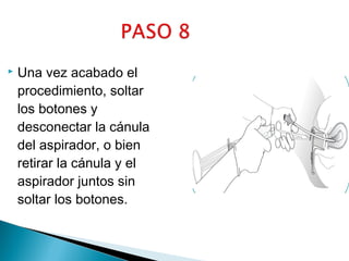 

Una vez acabado el
procedimiento, soltar
los botones y
desconectar la cánula
del aspirador, o bien
retirar la cánula y el
aspirador juntos sin
soltar los botones.

 