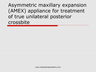Asymmetric maxillary expansion
(AMEX) appliance for treatment
of true unilateral posterior
crossbite
www.indiandentalacademy.com
 