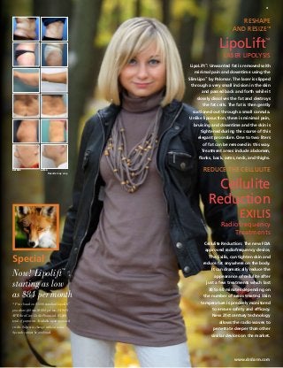 3

reshape
and resize™

LipoLift

™

Laser Lipolysis
LipoLift™: Unwanted fat is removed with
minimal pain and downtime using the
SlimLipo™ by Palomar. The laser is slipped
through a very small incision in the skin
and passed back and forth while it
slowly dissolves the fat and destroys
the fat cells. The fat is then gently
suctioned out through a small cannula.
Unlike liposuction, there is minimal pain,
bruising and downtime and the skin is
tightened during the course of this
elegant procedure. One to two liters
of fat can be removed in this way.
Treatment areas include abdomen,
flanks, back, arms, neck, and thighs.
BEFORE

reduce the cellulite

AFTER

Results may vary.

Cellulite
Reduction
exilis
Radiofrequency
Treatments
Cellulite Reduction: The new FDA
approved radiofrequency device,

Special
Now! Lipolift
starting as low
as $84 per month
™

* Price based on $3500 standard LipoLift
procedure. 60 mos @ $84 per mo. 14.90%
APR thru Care Credit Financial. $5,040
total of payments. Available upon approved
credit. Subject to change without notice.
Specials cannot be combined.
™

The Exilis, can tighten skin and
reduce fat anywhere on the body.
It can dramatically reduce the
appearance of cellulite after
just a few treatments which last
30 to 60 minutes depending on
the number of areas treated. Skin
temperature is precisely monitored
to ensure safety and efficacy.
New 21st century technology
allows the radio waves to
penetrate deeper than other
similar devices on the market.

www.drdarm.com

 