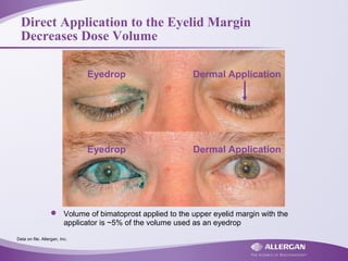 Direct Application to the Eyelid Margin
Decreases Dose Volume
Dermal ApplicationEyedrop
Eyedrop Dermal Application
 Volume of bimatoprost applied to the upper eyelid margin with the
applicator is ~5% of the volume used as an eyedrop
Data on file. Allergan, Inc.
 