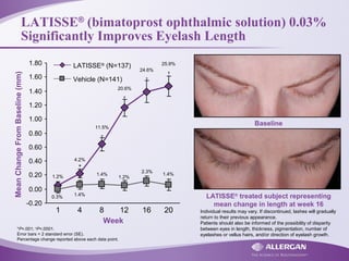 LATISSE®
(bimatoprost ophthalmic solution) 0.03%
Significantly Improves Eyelash Length
*P=.001; †P<.0001.
Error bars = 2 standard error (SE).
Percentage change reported above each data point.
MeanChangeFromBaseline(mm)
Week
1 4 8 12 16 20
†
†
†
†
*
-0.20
0.00
0.20
0.40
0.60
0.80
1.00
1.20
1.40
1.60
1.80
1.2%
1.4%
2.3%
1.2%
1.4%
1.4%0.3%
25.9%
24.6%
20.6%
11.5%
4.2%
LATISSE®
(N=137)
Vehicle (N=141)
LATISSE®
treated subject representing
mean change in length at week 16
Baseline
Individual results may vary. If discontinued, lashes will gradually
return to their previous appearance.
Patients should also be informed of the possibility of disparity
between eyes in length, thickness, pigmentation, number of
eyelashes or vellus hairs, and/or direction of eyelash growth.
 