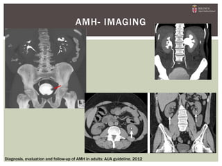 AMH- IMAGING
Diagnosis, evaluation and follow-up of AMH in adults: AUA guideline, 2012
 