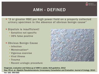  “3 or greater RBC per high power field on a properly collected
urinary specimen in the absence of obvious benign cause”
 Dipstick is insufficient!
 Sensitive not specific
 35% false positive
 Obvious Benign Cause
 Infection
 Menstruation*
 Vigorous exercise
 Viral illness
 Trauma
 Recent urologic procedure
AMH - DEFINED
Diagnosis, evaluation and follow-up of AMH in adults: AUA guideline, 2012
Rao, PK et. al.: Dipstick Pseudohematuria: Unnecessary Consultation and Evaluation. Journal of Urology. 2010.
Vol. 183. 560-565
 