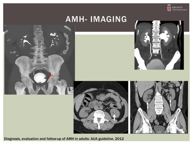Asymptomatic Microscopic Hemature : 2012 AUA Guidelines
