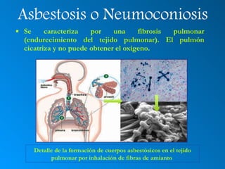 Asbestosis o Neumoconiosis Se caracteriza por una fibrosis pulmonar (endurecimiento del tejido pulmonar). El pulmón cicatriza y no puede obtener el oxígeno. Detalle de la formación de cuerpos asbestósicos en el tejido pulmonar por inhalación de fibras de amianto  
