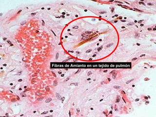 Fibras de Amianto en un tejido de pulmón 